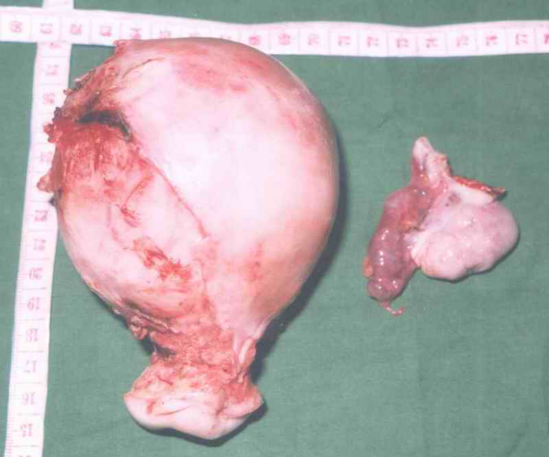 Soft Uterus of 400 gms With Tube And Ovary
